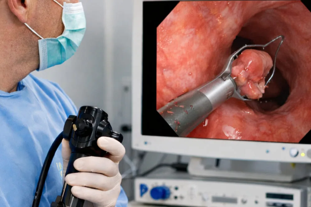 Resección de pólipos grandes: Procedimiento endoscópico para prevenir cáncer colorrectal